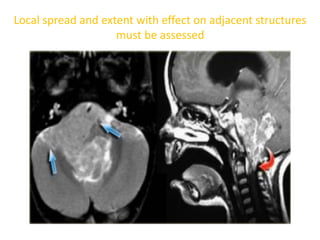 Local spread and extent with effect on adjacent structures
must be assessed
 