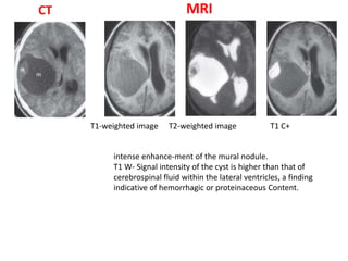 CT MRI
intense enhance-ment of the mural nodule.
T1 W- Signal intensity of the cyst is higher than that of
cerebrospinal fluid within the lateral ventricles, a finding
indicative of hemorrhagic or proteinaceous Content.
T2-weighted imageT1-weighted image T1 C+
 