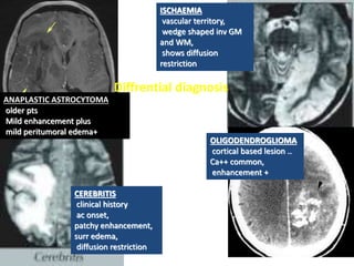 ISCHAEMIA
vascular territory,
wedge shaped inv GM
and WM,
shows diffusion
restriction
CEREBRITIS
clinical history
ac onset,
patchy enhancement,
surr edema,
diffusion restriction
OLIGODENDROGLIOMA
cortical based lesion ..
Ca++ common,
enhancement +
Diffrential diagnosis
ANAPLASTIC ASTROCYTOMA
older pts
Mild enhancement plus
mild peritumoral edema+
 