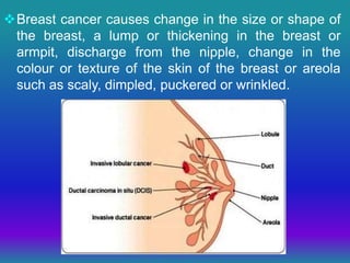 Breast cancer causes change in the size or shape of
the breast, a lump or thickening in the breast or
armpit, discharge from the nipple, change in the
colour or texture of the skin of the breast or areola
such as scaly, dimpled, puckered or wrinkled.
 