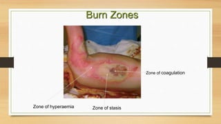 Zone of coagulation
Zone of stasisZone of hyperaemia
Burn Zones
 