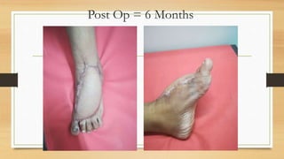 Post Op = 6 Months
 
