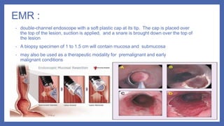 EMR :
• double-channel endoscope with a soft plastic cap at its tip. The cap is placed over
the top of the lesion, suction is applied, and a snare is brought down over the top of
the lesion
• A biopsy specimen of 1 to 1.5 cm will contain mucosa and submucosa
• may also be used as a therapeutic modality for premalignant and early
malignant conditions
 