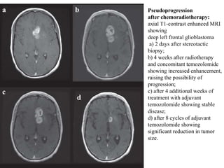 d
c
a b Pseudoprogression
after chemoradiotherapy:
axial T1-contrast enhanced MRI
showing
deep left frontal glioblastoma
a) 2 days after stereotactic
biopsy;
b) 4 weeks after radiotherapy
and concomitant temozolomide
showing increased enhancement,
raising the possibility of
progression;
c) after 4 additional weeks of
treatment with adjuvant
temozolomide showing stable
disease;
d) after 8 cycles of adjuvant
temozolomide showing
significant reduction in tumor
size.
 