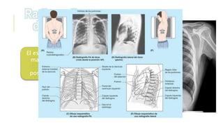 El estudio radiográfico
mas frecuente es la
proyección
posteroanterior (PA)
 
