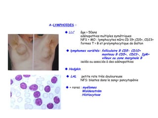 A-LYMPHOIDES :
 LLC âge > 50ans
adénopathies multiples symétriques
NFS + MO : lymphocytes mûrs CD 19+,CD5+, CD23+
formes T > B et prolymphocytique de Galton
 lymphomes variétés: folliculaire B CD5- CD10+
manteau B CD5+, CD23-, IgM+
villeux ou zone marginale B
isolés ou associés à des adénopathies
 Hodgkin
 LAL petite rate très douloureuse
NFS: blastes dans le sang+ pancytopénie
 + rares : myélomes
Waldenström
Histiocytose
 