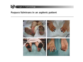 CAT dvt splenomegalie.pdf