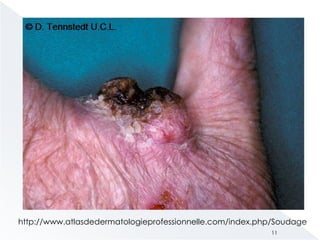 http://www.atlasdedermatologieprofessionnelle.com/index.php/Soudage
11
 