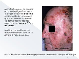 Multiples kératoses actiniques
en voie de dégénérescence
et dégénérées en carcinome
épidermoïde du visage ainsi
que volumineux carcinomes
épidermoïdes du dos des
mains chez un soudeur à l'arc
de 75 ans.
Le début de ses lésions est
aproximativement celui de sa
retraite à l'age de 65 ans.
http://www.atlasdedermatologieprofessionnelle.com/index.php/Soudage
9
 