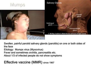Mumps




Swollen, painful parotid salivary glands (parotitis) on one or both sides of
the face
Etiology: Mumps virus (Myxovirus)
Fever and sometimes orchitis, pancreatitis etc.
About 1/3 of infected people do not show symptoms

Effective vaccine (MMR)             since 1967
 