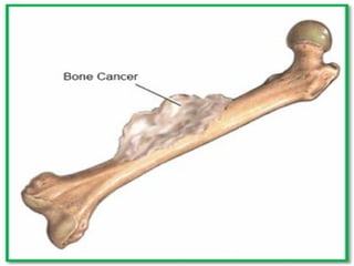 Chemotherapy of cancer