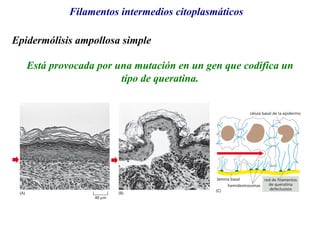 Filamentos intermedios citoplasmáticos
Epidermólisis ampollosa simple
Está provocada por una mutación en un gen que codifica un
tipo de queratina.
 
