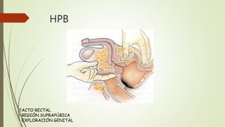 HPB
TACTO RECTAL
• REGIÓN SUPRAPÚBICA
• EXPLORACIÓN GENITAL
 