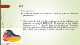 HPB
Anatomía patológica
 La HBP se origina en la zona de Transición y en las Glándulas
periuretrales
 Hiperplasia del estroma fibromuscular y de las glándulas que
adquieren un aspecto NODULAR. El aumento de los nódulos
(aparecen en la 4ª década) hace que la zona de Transición
aumente y comprima a las demás zonas de la próstata. La uretra,
que va dentro de la zona de transición se verá sí comprimida.
 