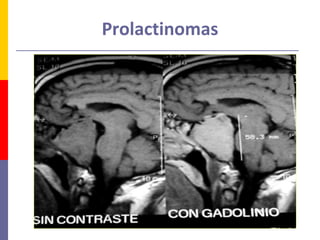 Prolactinomas
 