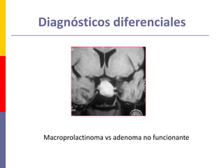 Macroprolactinoma vs adenoma no funcionante
Diagnósticos diferenciales
 