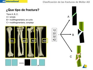 Clasificación de las fracturas de Müller AO
12- 22-22- 32-32- 42-42-
12
22
32
42
-
A
B
C
— .
¿Que tipo de fractura?
Tipos A, B, C:
A = simple
B = multifragmentaria, en cuña
C = multifragmentaria, compleja
 