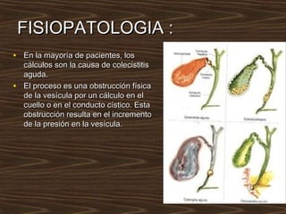 FISIOPATOLOGIA :FISIOPATOLOGIA :
• En la mayoría de pacientes, losEn la mayoría de pacientes, los
cálculos son la causa de colecistitiscálculos son la causa de colecistitis
aguda.aguda.
• El proceso es una obstrucción físicaEl proceso es una obstrucción física
de la vesícula por un cálculo en elde la vesícula por un cálculo en el
cuello o en el conducto cístico. Estacuello o en el conducto cístico. Esta
obstrucción resulta en el incrementoobstrucción resulta en el incremento
de la presión en la vesícula.de la presión en la vesícula.
 