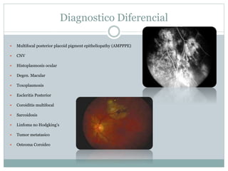 Diagnostico Diferencial
 Multifocal posterior placoid pigment epitheliopathy (AMPPPE)
 CNV
 Histoplasmosis ocular
 Degen. Macular
 Toxoplasmosis
 Escleritis Posterior
 Coroiditis multifocal
 Sarcoidosis
 Linfoma no Hodgking’s
 Tumor metatasico
 Osteoma Coroideo
 