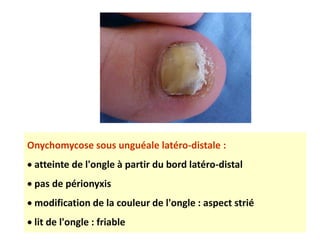Onychomycose sous unguéale latéro-distale :
 atteinte de l'ongle à partir du bord latéro-distal
 pas de périonyxis
 modification de la couleur de l'ongle : aspect strié
 lit de l'ongle : friable
 