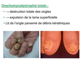Onychomycodystrophie totale :
 → destruction totale des ongles
 → expulsion de la lame superficielle
 Lit de l’ongle parsemé de débris kératiniques
 