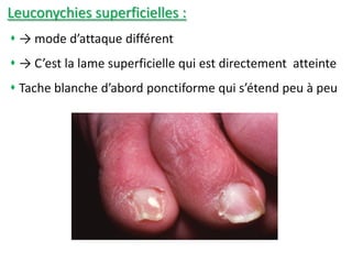 Leuconychies superficielles :
 → mode d’attaque différent
 → C’est la lame superficielle qui est directement atteinte
 Tache blanche d’abord ponctiforme qui s’étend peu à peu
 