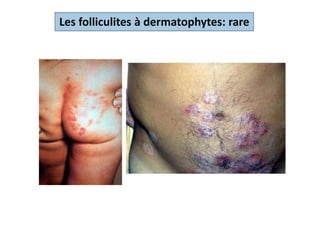 Les folliculites à dermatophytes: rare
 