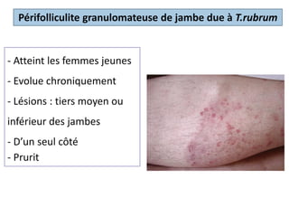 Atteint les femmes jeunes
Evolue chroniquement
Lésions siègent sur le tiers
moyen
ou inférieur des jambes
D’un seul côté
Prurit
Périfolliculite granulomateuse de jambe due à T.rubrum
- Atteint les femmes jeunes
- Evolue chroniquement
- Lésions : tiers moyen ou
inférieur des jambes
- D’un seul côté
- Prurit
 