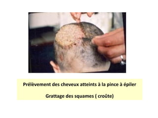 Prélèvement des cheveux atteints à la pince à épiler
Grattage des squames ( croûte)
 