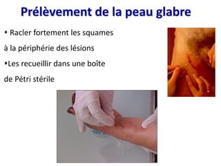 Prélèvement de la peau glabre
 Racler fortement les squames
à la périphérie des lésions
Les recueillir dans une boîte
de Pétri stérile
 