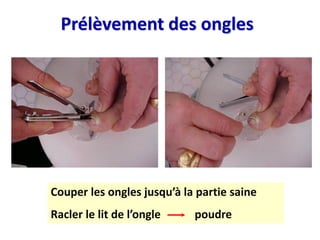 Couper les ongles jusqu’à la partie saine
Racler le lit de l’ongle poudre
Prélèvement des ongles
 