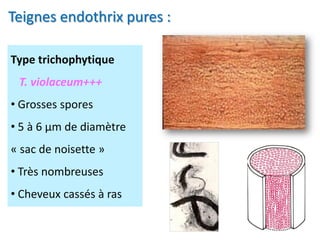 Type trichophytique
T. violaceum+++
• Grosses spores
• 5 à 6 µm de diamètre
« sac de noisette »
• Très nombreuses
• Cheveux cassés à ras
Teignes endothrix pures :
 