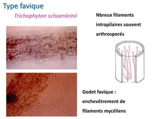 Type favique
Nbreux filaments
intrapilaires souvent
arthrosporés
Godet favique :
enchevêtrement de
filaments mycéliens
Trichophyton schoenleinii
 