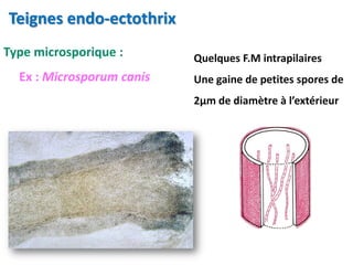 Type microsporique :
Ex : Microsporum canis
Quelques F.M intrapilaires
Une gaine de petites spores de
2µm de diamètre à l’extérieur
Teignes endo-ectothrix
 