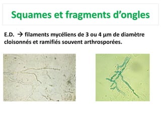 Squames et fragments d’ongles
E.D.  filaments mycéliens de 3 ou 4 µm de diamètre
cloisonnés et ramifiés souvent arthrosporées.
 
