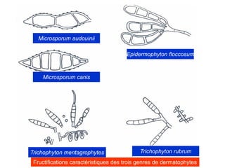 Epidermophyton floccosum
Microsporum audouinii
Microsporum canis
Trichophyton rubrum
Trichophyton mentagrophytes
Fructifications caractéristiques des trois genres de dermatophytes
 