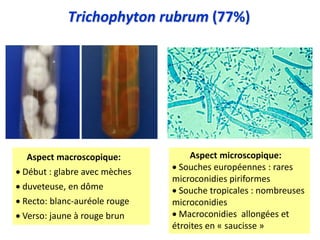 Trichophyton rubrum (77%)
Aspect macroscopique:
 Début : glabre avec mèches
 duveteuse, en dôme
 Recto: blanc-auréole rouge
 Verso: jaune à rouge brun
Aspect microscopique:
 Souches européennes : rares
microconidies piriformes
 Souche tropicales : nombreuses
microconidies
 Macroconidies allongées et
étroites en « saucisse »
 