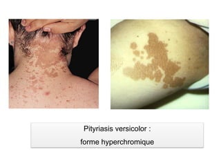 Pityriasis versicolor :
forme hyperchromique
 