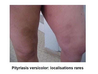 cours dermatophytes+mlassezia -epu 27-10- 2020.pdf