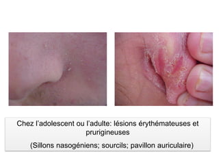 Chez l’adolescent ou l’adulte: lésions érythémateuses et
prurigineuses
(Sillons nasogéniens; sourcils; pavillon auriculaire)
 