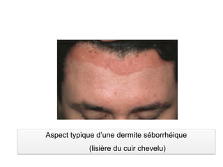 Aspect typique d’une dermite séborrhéique
(lisière du cuir chevelu)
 
