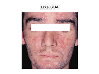 DS et SIDA
 