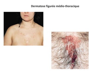 Dermatose figurée médio-thoracique
 