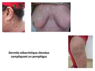 Dermite séborrhéique étendue
compliquant un pemphigus
 