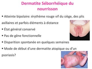 Dermatite Séborrhéique du
nourrisson
 Atteinte bipolaire: érythème rouge vif du siège, des plis
axillaires et parfois éléments à distance
 État général conservé
 Pas de gêne fonctionnelle
 Disparition spontanée en quelques semaines
 Mode de début d’une dermatite atopique ou d’un
psoriasis?
 