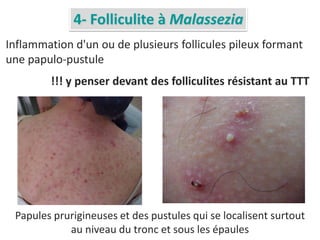 4- Folliculite à Malassezia
Papules prurigineuses et des pustules qui se localisent surtout
au niveau du tronc et sous les épaules
Inflammation d'un ou de plusieurs follicules pileux formant
une papulo-pustule
!!! y penser devant des folliculites résistant au TTT
 