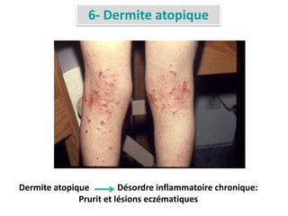 6- Dermite atopique
Dermite atopique Désordre inflammatoire chronique:
Prurit et lésions eczématiques
 