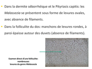  Dans la dermite séborrhéique et le Pityriasis capitis: les
Malassezia se présentent sous forme de levures ovales,
avec absence de filaments.
 Dans la folliculite du dos: manchons de levures rondes, à
paroi épaisse autour des duvets (absence de filaments).
Examen direct d’une folliculite:
nombreuses
levures du genre Malassezia
 
