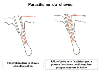 Parasitisme du cheveu
Pénétration dans le cheveu
et multiplication
F.M. refoulés vers l’extérieur par la
pousse du cheveu continuent leur
progression vers le bulbe
 