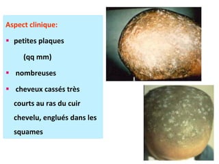 Aspect clinique:
 petites plaques
(qq mm)
 nombreuses
 cheveux cassés très
courts au ras du cuir
chevelu, englués dans les
squames
 